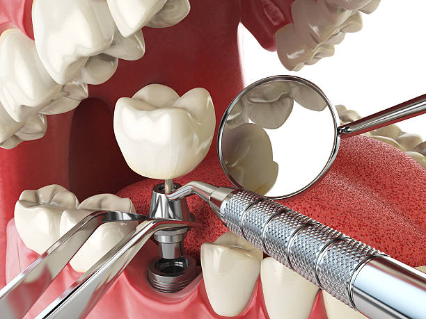 Best Emergency Tooth Extraction in Canby, OR